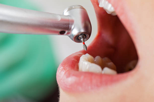 Best Emergency Tooth Extraction in Ellitt, CO